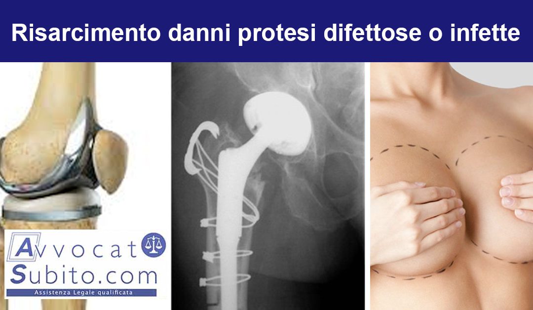Protesi Ortopediche: Rischi, Complicazioni e Opportunità di Risarcimento