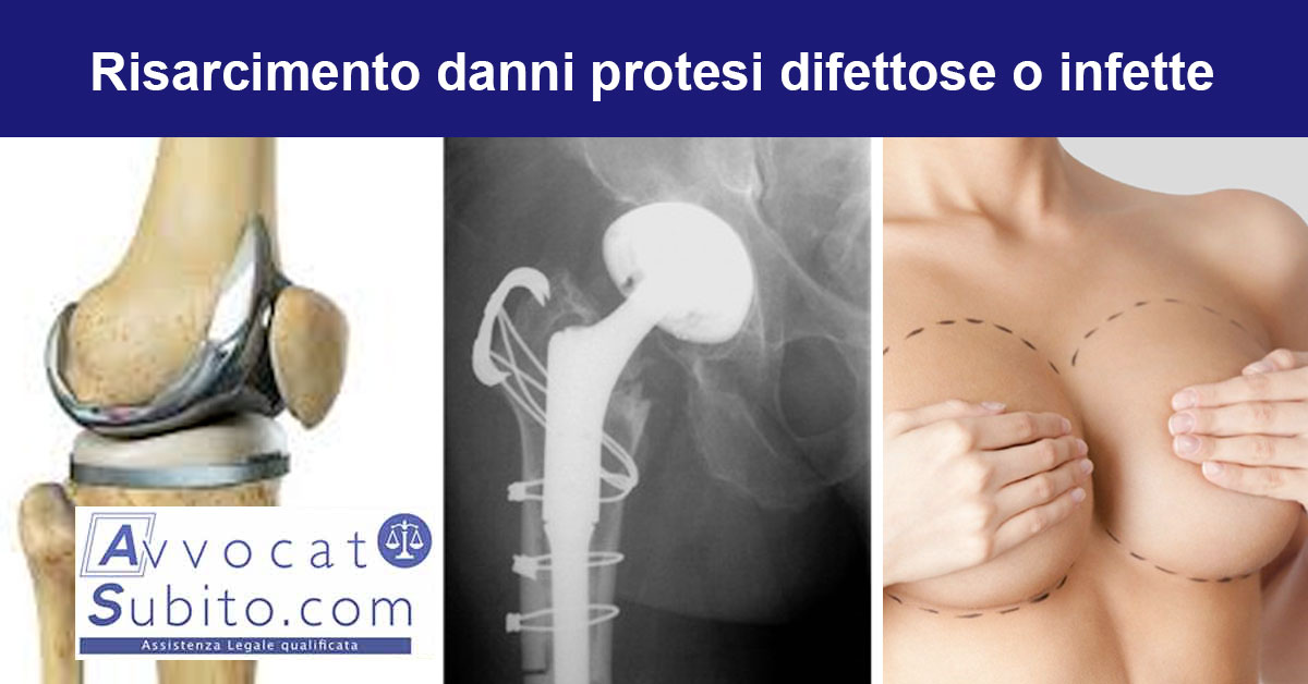Protesi difettose o infette - Risarcimento danni